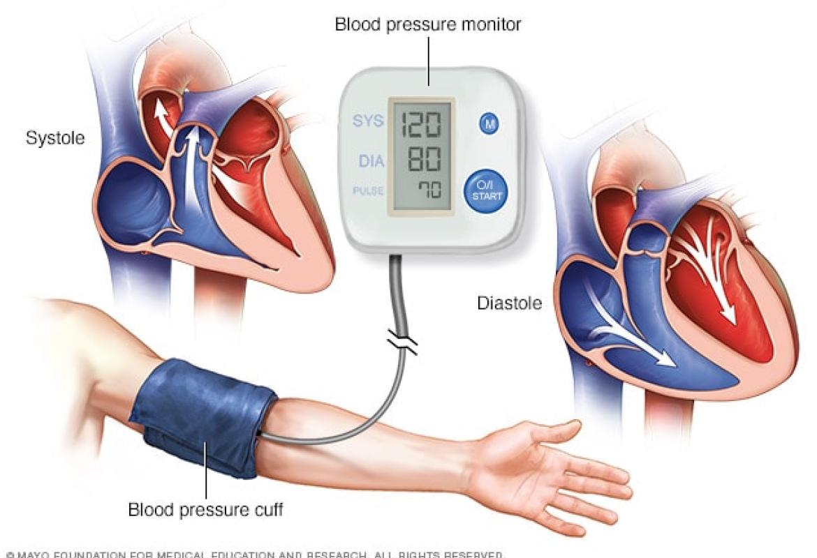 ارتفاع ضغط الدم 